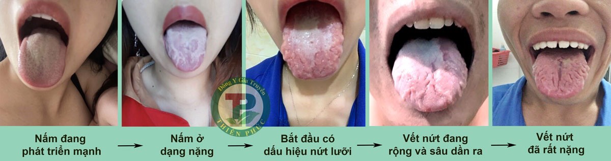 TẤT TẦN TẬT VỀ BỆNH NẤM MIỆNG